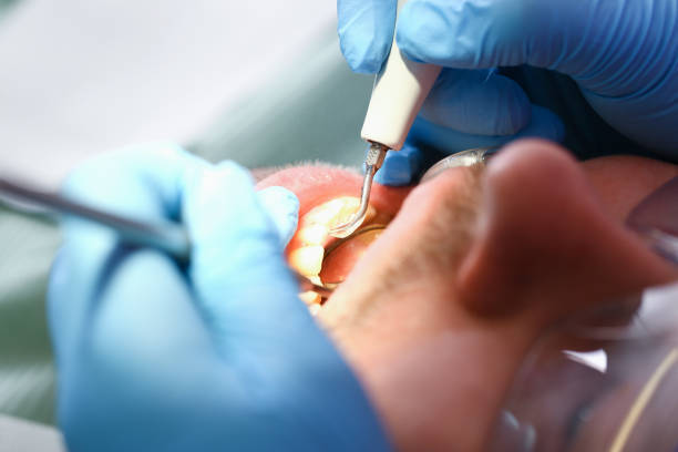 Best Root Canal Emergency Dentist  in Wauseon, OH